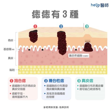 身體側邊有痣|痣形成的原因？痣長毛、痣變多變大是痣病變？5招判別